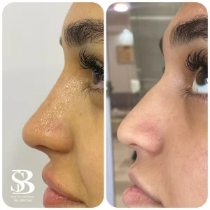 فیلر بینی - بیوتی صالحان