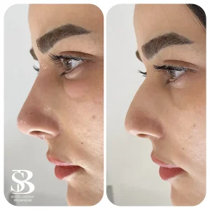 فیلر بینی - بیوتی صالحان