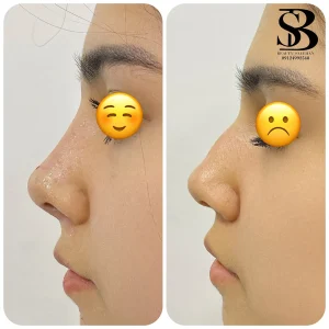 فیلر بینی - بیوتی صالحان