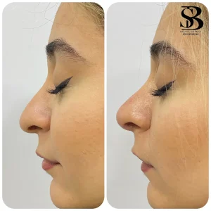 فیلر بینی - بیوتی صالحان