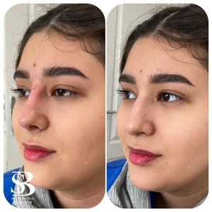 فیلر بینی - بیوتی صالحان