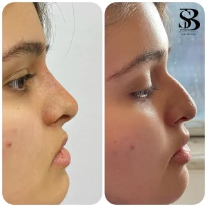 فیلر بینی - بیوتی صالحان