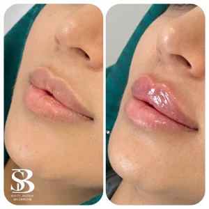 نمونه کار لب - کلینیک بیوتی صالحان