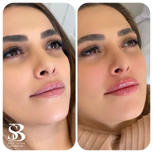 نمونه کار لب - کلینیک بیوتی صالحان