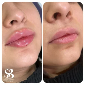 نمونه کار لب - کلینیک بیوتی صالحان