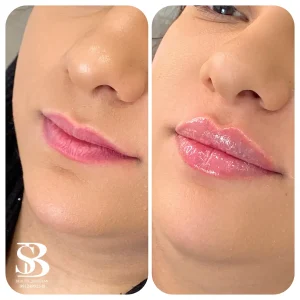 نمونه کار لب - کلینیک بیوتی صالحان