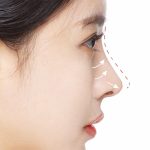 اصلاح فرم بینی بدون جراحی