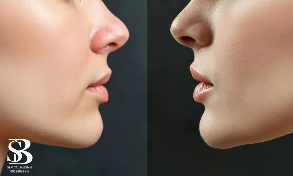 تزریق فیلر چانه