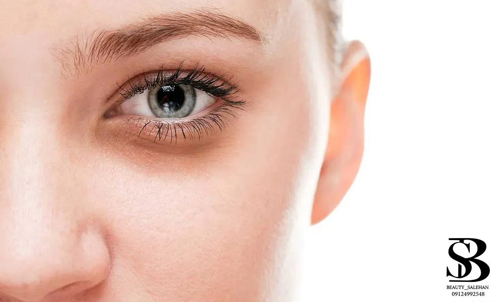 فیلر زیرچشم