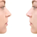 درمان لک و جوش