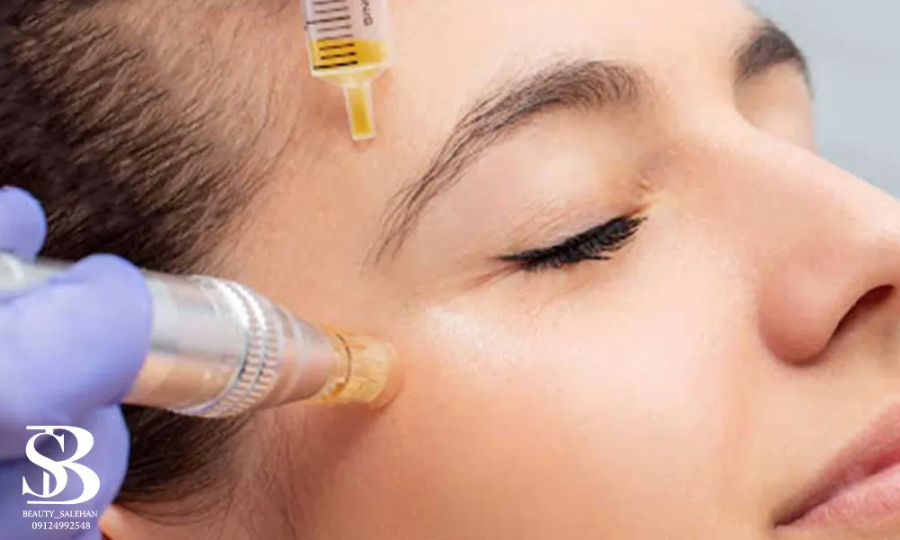 مزونیدلینگ و میکرونیدلینگ