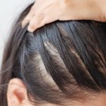 درمان ریزش مو