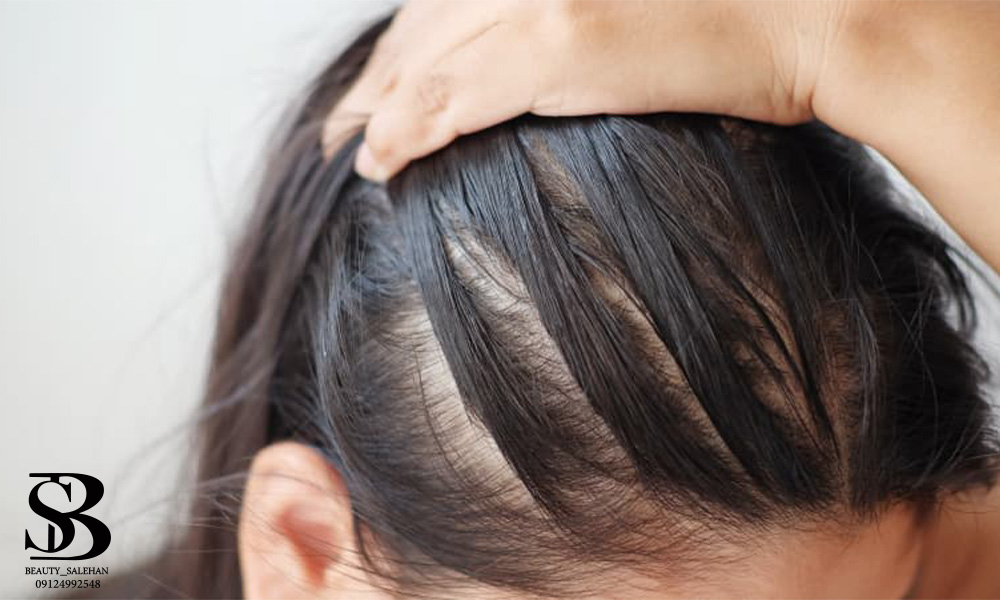 درمان ریزش مو