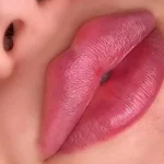 تزریق فیلر لب روسی