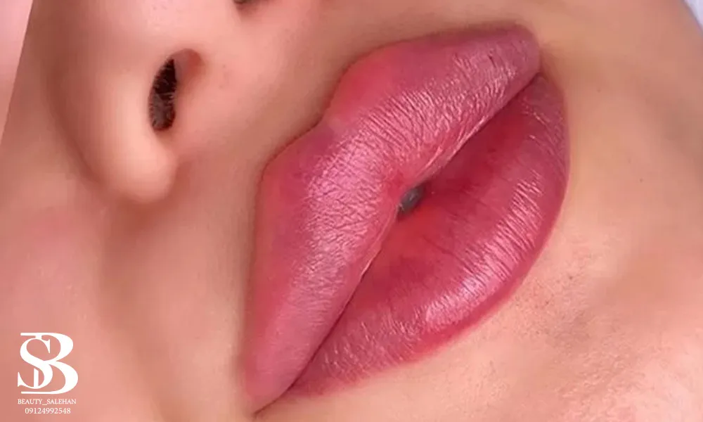 تزریق فیلر لب روسی